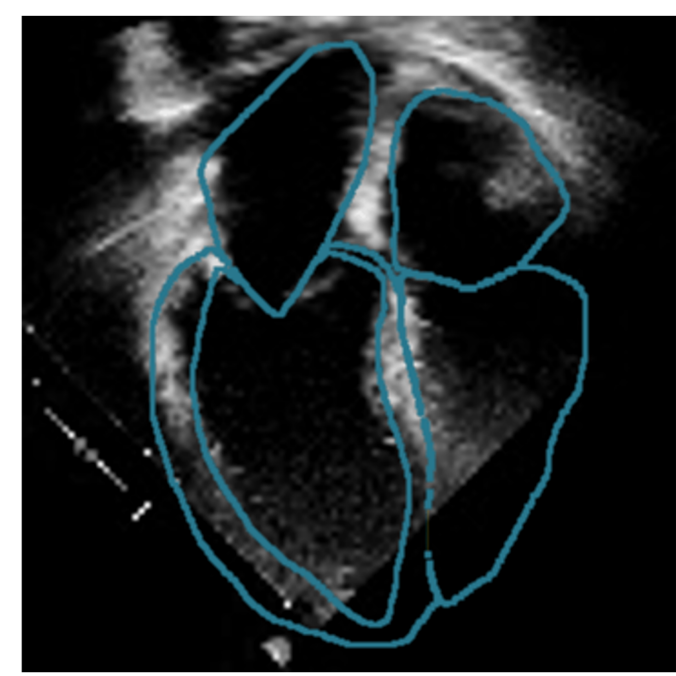 heart ecography image with heart chambers drawn over the picture in a blue line