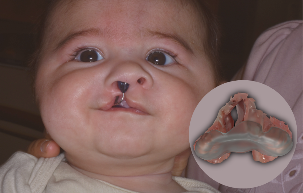 A baby wears the first palatal plate